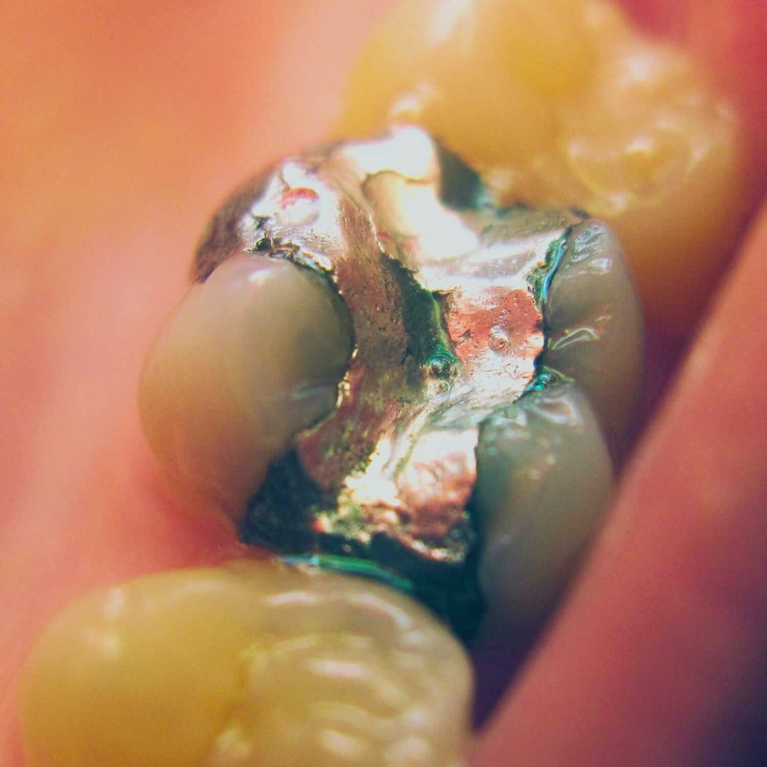 silverfilling Gulfview Dentistry Dean Mourselas Naples, FL